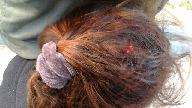 The head wound the girl suffered (Photo: B'Tselem)