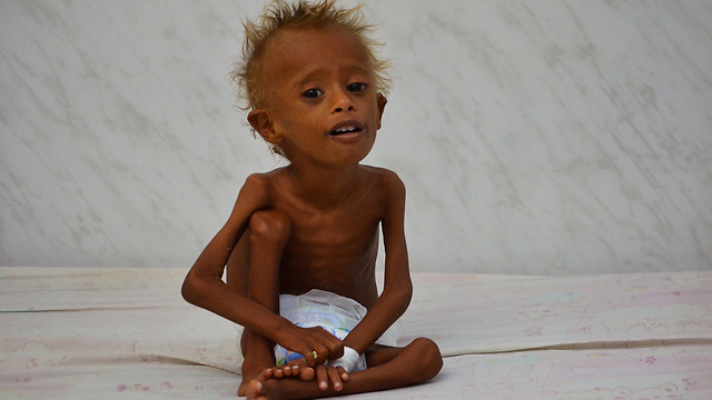Yemeni child malnourished due to the fighting (Photo: Reuters)