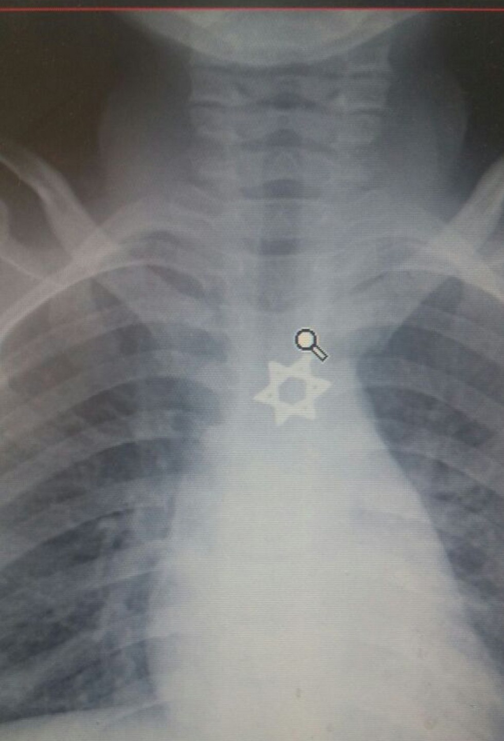 Boy named Daud swallows Star of David, saved by doctors