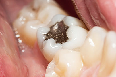 סתימה כסופה. בגלל הצבע בדרך כלל בשימוש  בשיניים בחלקים פחות קדמיים (צילום: Shutterstock) (צילום: Shutterstock)