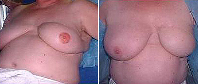 משמאל: שחזור פטמות באיפור קבוע, לאחר כריתת השד (צילום: באדיבות אתי וולף) (צילום: באדיבות אתי וולף)