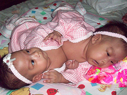 התאומות לאחר הלידה. חלקו איברים פנימיים (צילום: רויטרס) (צילום: רויטרס)