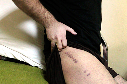 אבו סלימן, אחד הפצועים. מציג את צלקותיו (צילום: AP) (צילום: AP)