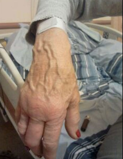 היד הנפוחה של תרצה אריאל (צילום: ענת פיטוסי) (צילום: ענת פיטוסי)