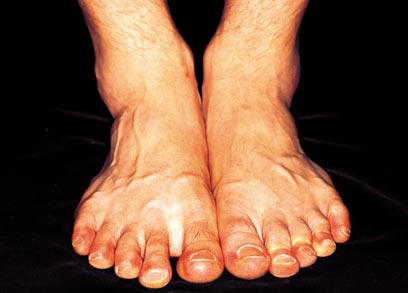 הכאב הנוירופתי אצל חול סוכרת מופיע בכפותהרגליים (צילום: ויז'ואל/פוטוס) (צילום: ויז'ואל/פוטוס)