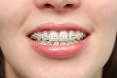 חוטי המתכת מפעילים כוחות על השיניים לסגירת המרווח (צילום: shutterstock  ) (צילום: shutterstock  )