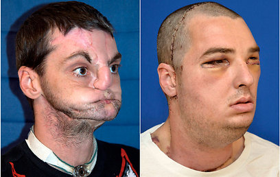 נוריס לפני (משמאל) ואחרי הניתוח (צילום: רויטרס) (צילום: רויטרס)