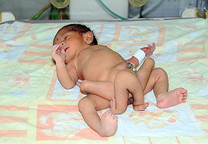 התינוק עומר פארוק עם שש רגליים (צילום: AFP PHOTO /HO/NICH) (צילום: AFP PHOTO /HO/NICH)