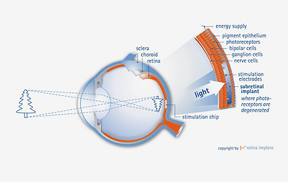  (איור: retina implant AG) (איור: retina implant AG)