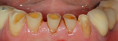 במצבים חמורים נגרמת פגיעה חמורה בשיניים הגורמת לשבירת שיניים ולכאבי פנים ולסתות  (צילום: ד"ר דן גורדון) (צילום: ד
