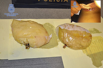השתלים שהוצאו מגופה של האישה (צילום: EPA) (צילום: EPA)