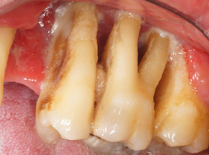 מחלת החניכיים האחראית העיקרית לאובדן שיניים בבני 40 ומעלה (צילום : ד"ר עירן פרוינט) (צילום : ד