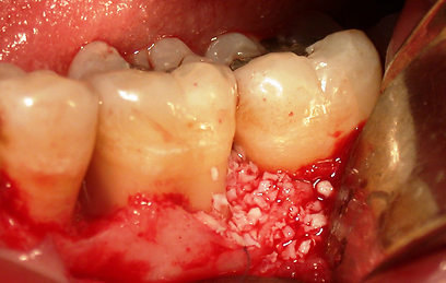 השתלים נספגים ומהווים תשתית ביולוגית לשיניים (צילום : ד"ר עירן פרוינט) (צילום : ד