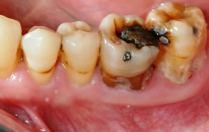 מצבים שעוזרים להחליט מתי הגיע הזמן לוותר על השן (צילום: ד"ר דן גורדון) (צילום: ד