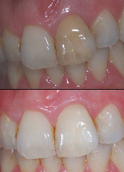 לפני ההלבנה (למעלה) ואחריה. האסטיקה של השיניים הקדמיות מאוד חשובה (צילום: ד"ר דן גורדון) (צילום: ד