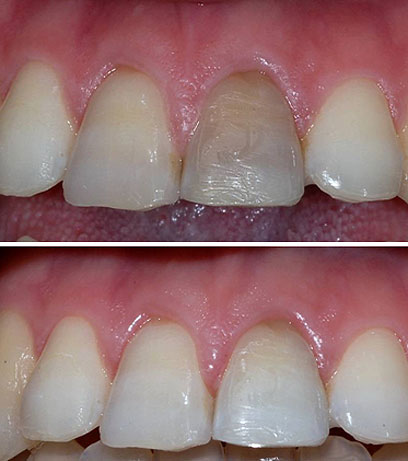 לפני ההלבנה (למעלה) ואחריה. שיטה השומרת על השיניים למשך זמן רב (צילום: ד"ר דן גורדון) (צילום: ד