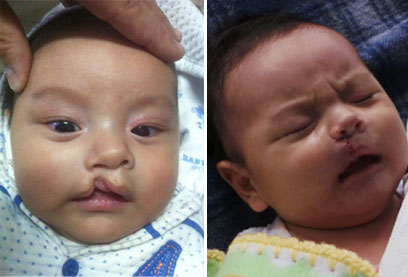 התינוק אדוארדו לפני הניתוח (משמאל) ועם השפתיים החדשות (צילום: דורון קופרשטין) (צילום: דורון קופרשטין)