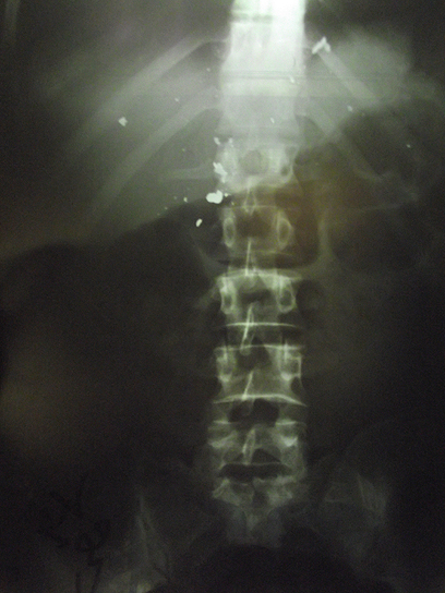 הכדור הגיע לאזור עמוד השדרה  (צילום: זכריה סדה, רבנים למען זכויות האדם)