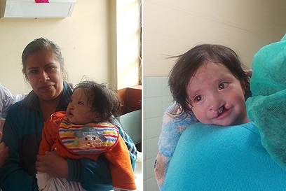 אמיר בן ה-8 חודשים לפני הניתוח (מימין) ואחריו. בקושי ראה אור יום (צילום: דורון קופרשטין) (צילום: דורון קופרשטין)