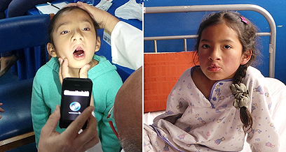 אסתר בת ה-6 לפני הניתוח (משמאל) ואחריו. החזירו את התחושה לשרירי הפה (צילום: דורון קופרשטין) (צילום: דורון קופרשטין)