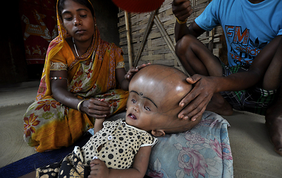 לפני הניתוח. היקף הראש כשנולדה - 91 ס"מ (צילום: AFP) (צילום: AFP)