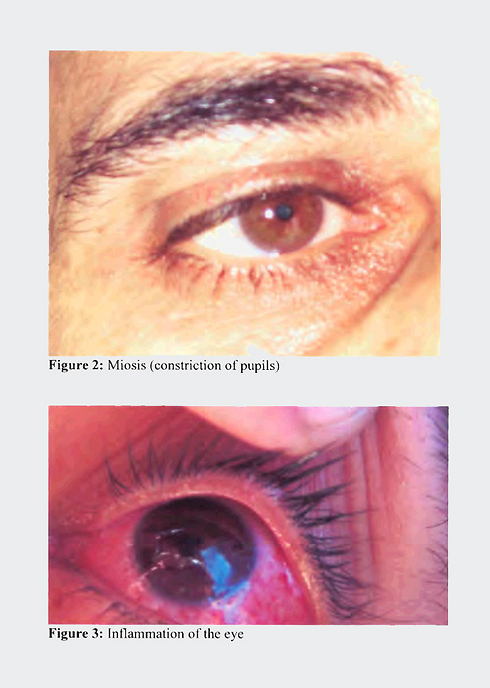 בין התסמינים שפיתחו הנפגעים - גירוי בעיניים, ראייה מטושטשת. מתוך דו"ח האו"ם ()