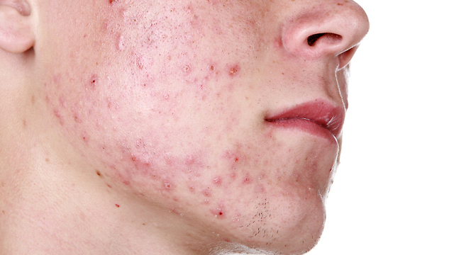 הגנה על העור כדי להימנע מהפצעונים. אקנה (צילום: shutterstock) (צילום: shutterstock)