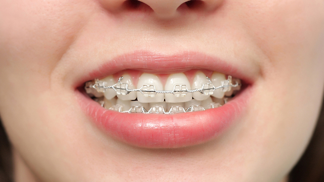 אין קשר לעונות השנה כשמגיעים ליישור שיניים (צילום: shutterstock  ) (צילום: shutterstock  )