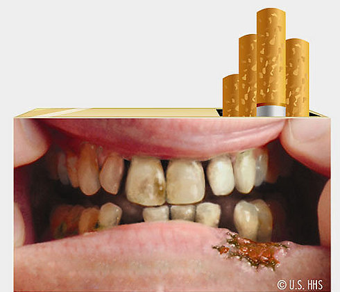 פרסומות נגד עישון שפרסם ה-FDA. המודעות הרבה לנזקים לא ממש עוזרת להפחתת שיעור העישון ()
