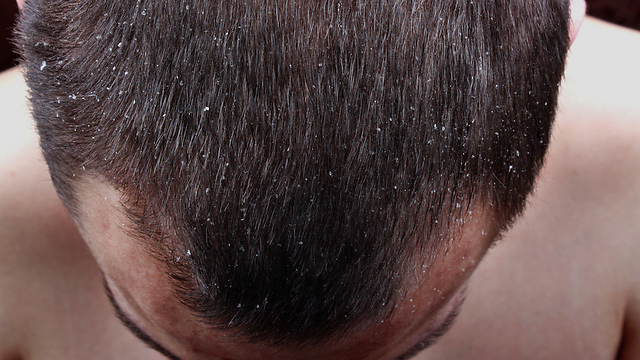 הוויטמינים מחזקים את השיער. היתרונות בשקדים (צילום: shutterstock) (צילום: shutterstock)