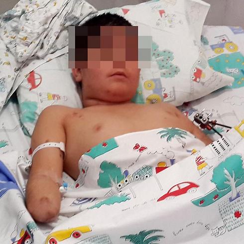 ידו נקטעה בבית חולים בלבנון. הילד במרכז הרפואי זיו (צילום: באדיבות בי"ח זיו) (צילום: באדיבות בי