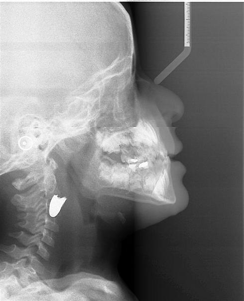 צילום הרנטגן של הילד, עם הקליע בצווארו. נתקע במיקום מסוכן (באדיבות בית החולים רמב"ם) (באדיבות בית החולים רמב