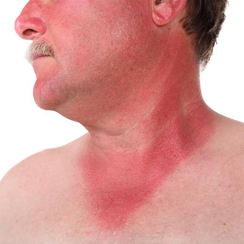 עובד שנשחף לשמש וחלה בסרטן העור, יכול להיחשב כנפגע עבודה (צילום: shutterstock) (צילום: shutterstock)