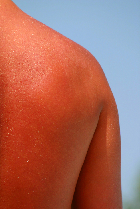 העור שלכם זוכר כל חשיפה ופגיעה מהשמש (צילום: shutterstock) (צילום: shutterstock)