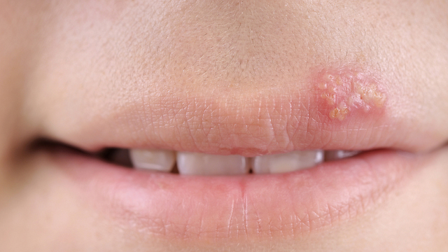 אותו נגיף של הרפס יכול להופיע גם על השפתיים וגם באיברי המין (צילום: shutterstock) (צילום: shutterstock)