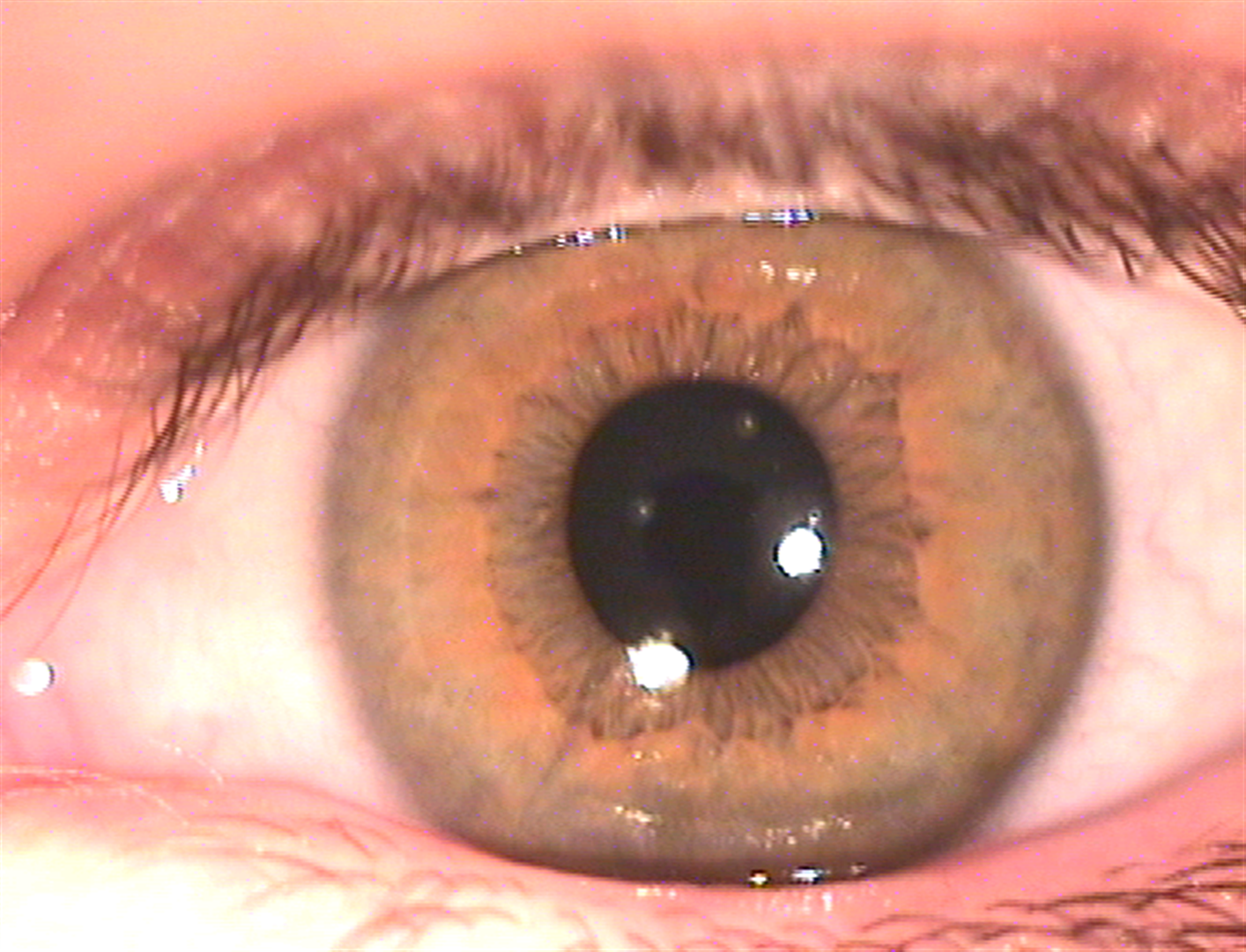 עין בגוון כתום - מצביעה על סוכרת ( ) ( )