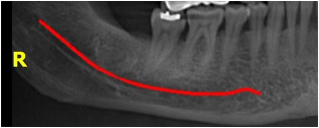 קטע מתוך צילום CT בו מסומן בצבע אדום מסלול עצב הלסת התחתונה (inferior alveolar nerve).  ( ) ( )