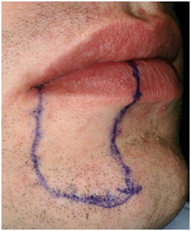  צילום קליני של מתרפא, המדגים מיפוי של מקטע מהשפה התחתונה עם ירידה בתחושה, בעקבות פגיעה בעצב הלסת התחתונה בצד ימין.  ( ) ( )
