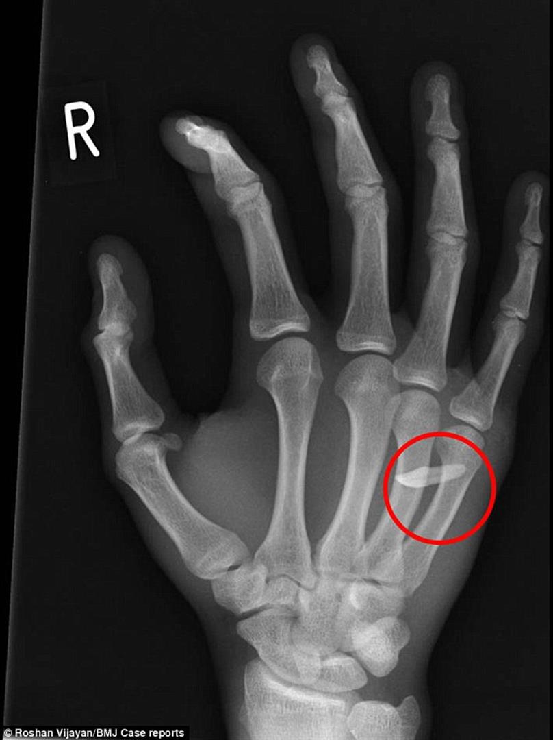 צילום הרנטגן שמראה את השן הנעוצה ביד ()