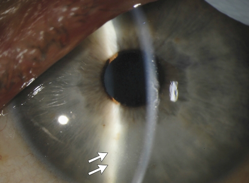 עינו של קרוז'ייר שבה נראית דלקת מסוג אובאיטיס העלולה לגרום לעיוורון (צילום: כתב העת לרפואה של ניו אינגלנד)