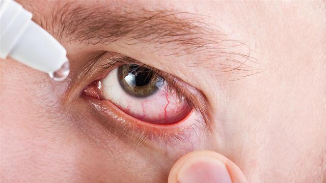 לבחור את הטיפות הנכונות. טיפול בעין אדומה (צילום: shutterstock) (צילום: shutterstock)