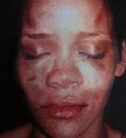 Rihanna's bruised face after being assaulted by Chris Brown. 'The message is that you can beat up a woman and there will be no consequences' 