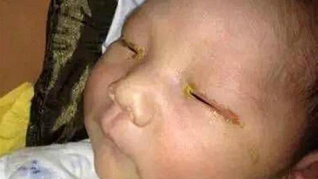 התינוק שהתעוור. הפלאש גרם לנזק בקרנית ()