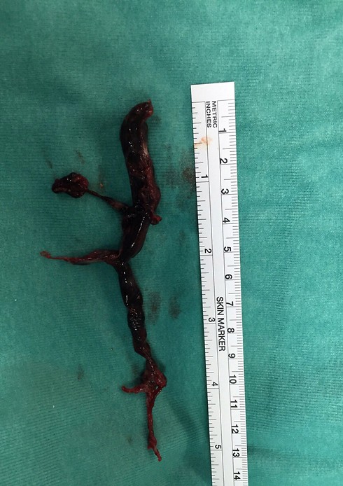 The aformentioned clot (Photo: Rabin Medical Center) 
