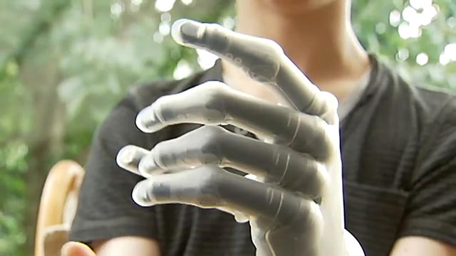 Assaf Yasur's bionic prosthetic