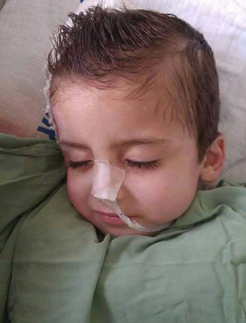 Ahmad Dawabsheh after his bandages were removed two months after the attack.
