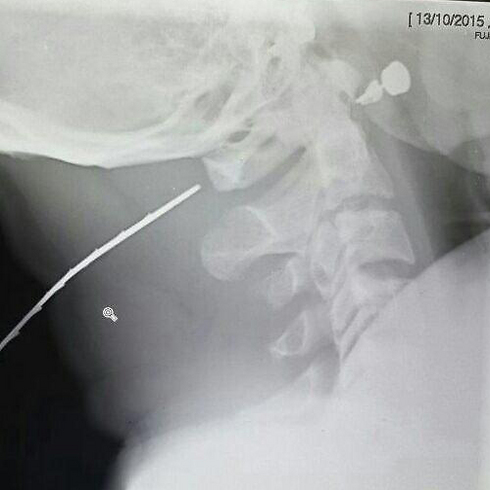 דקירה בצוואר: צילום רנטגן של פצוע מהפיגוע ברעננה (צילום: בית חולים מאיר) (צילום: בית חולים מאיר)