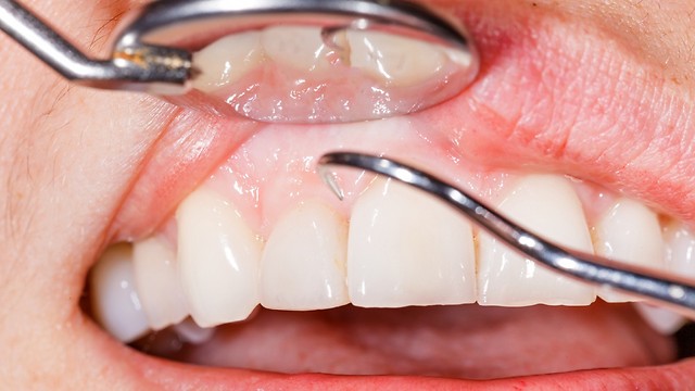 לוודא שאי אפשר לשמור על השיניים הטבעיות לפני ההשתלה (צילום: shutterstock) (צילום: shutterstock)