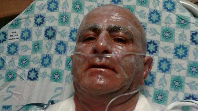 Moshe Hen, who suffered burns all over his body when a Palestinian tried to blow up her car at a checkpoint in the West Bank