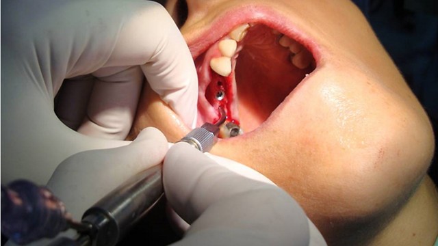 שימוש באנדוסקופ במהלך השתלת שיניים ( ) ( )